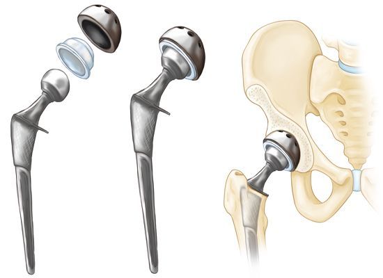 hip post op