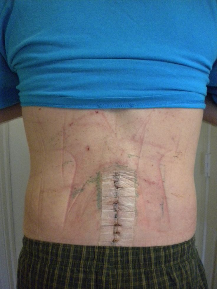 spinal surgery post op