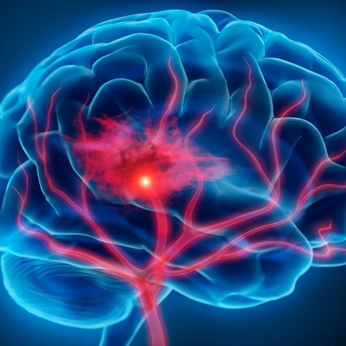 Neurological Physiotherapy at Home Perth